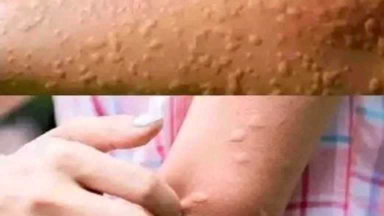 Le picaba todo el cuerpo, pensaba que era alergia y le diagnosticaron un cancer poco común hoy en día  …Ver más