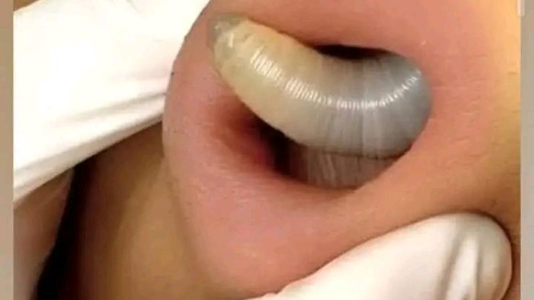 Encuentra larva en el 4n0 de una joven después de haber hecho esto todos lo detalles los tendrás tocando el texto azul… Ver más