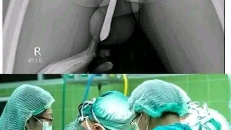 Un hombre termina en hospital, el objeto se rompió en el intestino ya que intento que entrara completo y parece que no calculo que podría suceder esto y termino en el hospital… Ver más