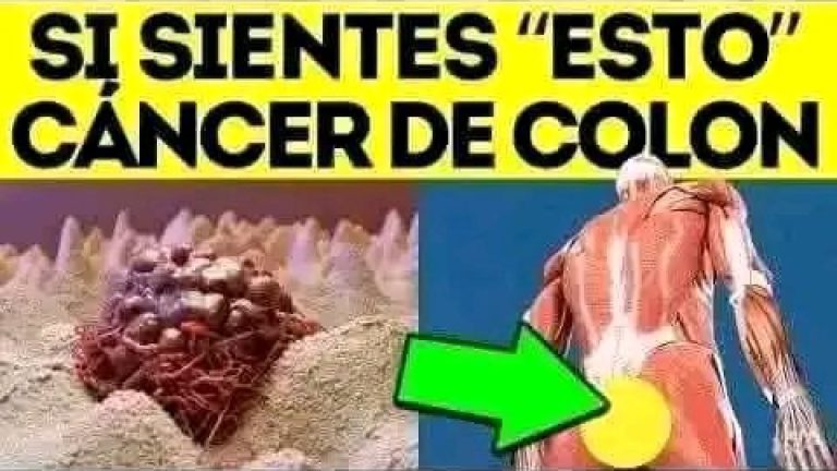 Síntomas del Cáncer de Colon: Reconoce las señales y todos los síntomas para si tines alguno acudas de inmediato al doctor de seguro me lo agradeceras…Ver más