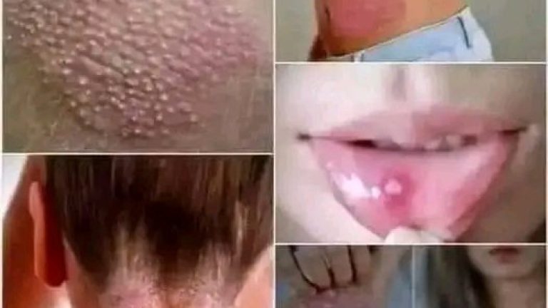 Estas son las 10 cosas que debes saber del papiloma humano antes de tener relaciones sexuales.