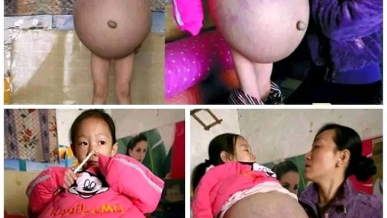 La niña lloraba del dolor, su vientre crecía y le dijeron q tenía 8 meses de embarazo, pero cuando el médico lo saco quedaron asombrados.