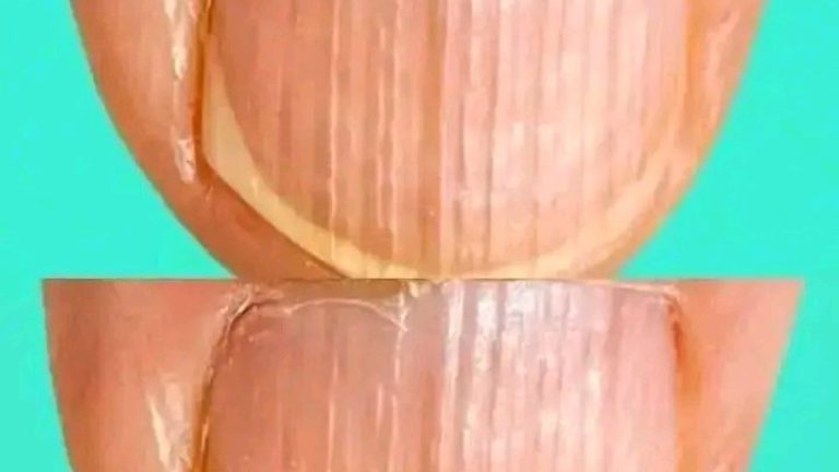 Tener asi con Rayas las uñas son el significado de que a tu cuerpo le.. Ver mas