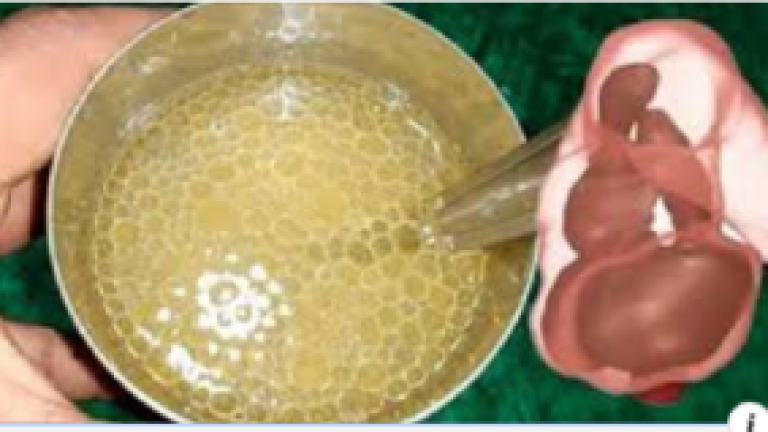 Remedio para el estreñimiento