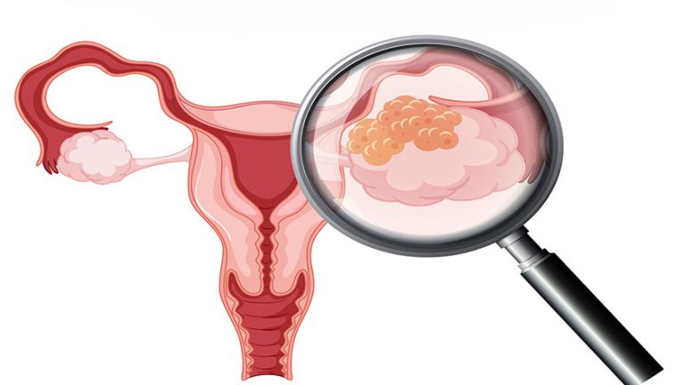 Cáncer de ovario: síntomas, diagnóstico y tratamiento