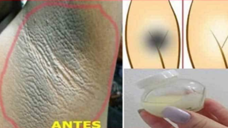 ELIMINAR LAS MANCHAS OSCURAS
