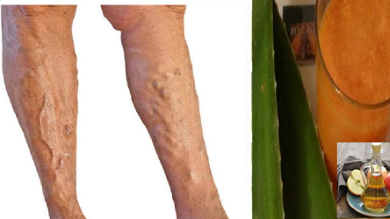 Venas Varicosas